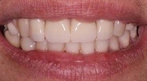 Smile after tooth decay is corrected