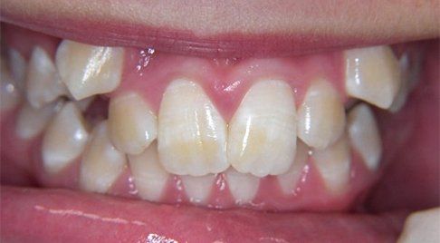 Smile with impacted canine teeth