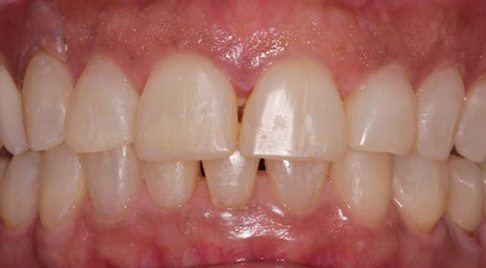 Smile after dental discoloration is corrected