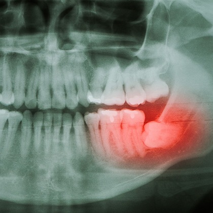 a dental X-ray showing an impacted wisdom tooth