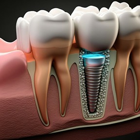 a 3 D illustration of osseointegration and dental implant abutment