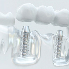 an illustration of an implant bridge in Lake Nona, FL