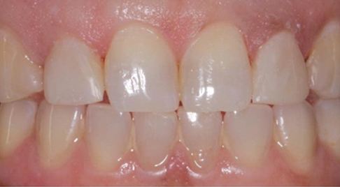 Smile after yellowed teeth are brightened