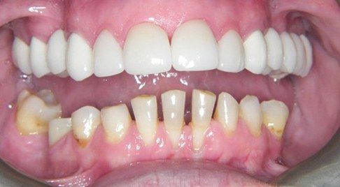 Smile after worn teeth are repaired