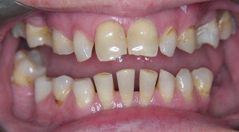 Smile with severe dental wear before dentistry solutions
