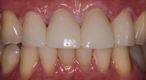 Smile after dental wear and gaps are repaired