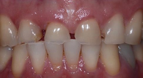 Smile with worn teeth and large gaps