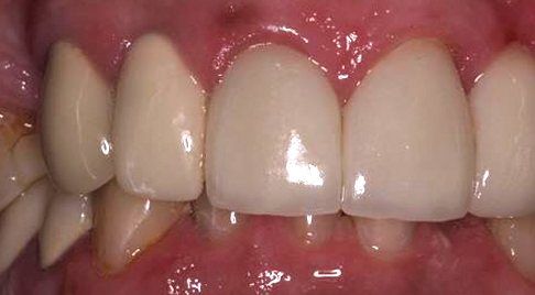 Smile after front tooth dental decay is repaired