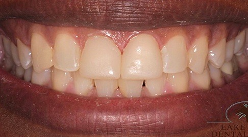 Smile after darkened tooth is repaired