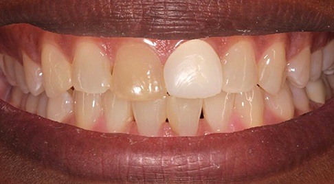 Smile with one darkly discolored front tooth