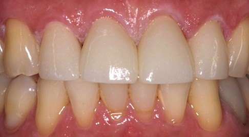 Smile after dental wear and gaps are corrected