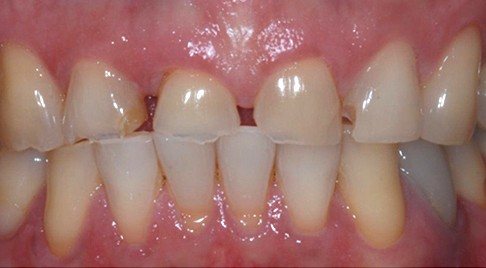 Smile with worn teeth and large gaps between teeth
