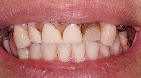 Smile with tooth decay around the gum line