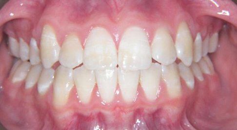 Smile after impacted canines are corrected