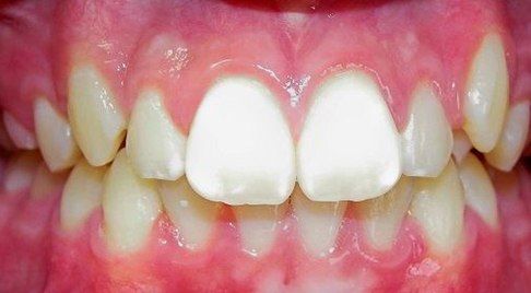 Smile with dental discoloration before treatment