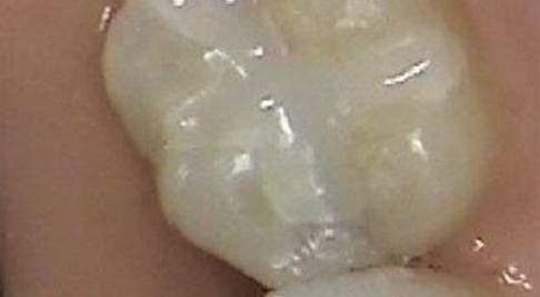 Tooth with tooth colored filling