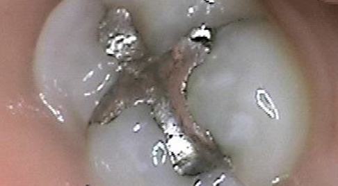 Tooth with metal filling