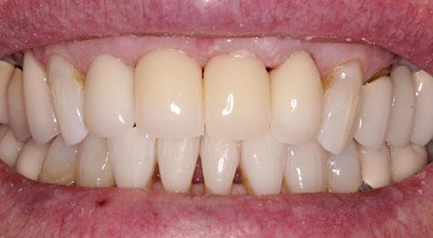 Smile flawlessly restored after treatment