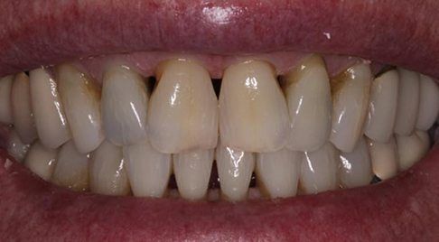 Teeth with gum recession and decay before dental treatment