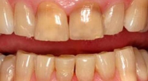 Worn and discolored teeth before dental treatment