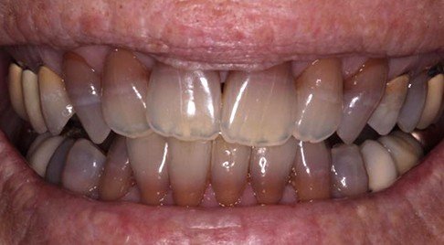 Severely discolored and worn teeth