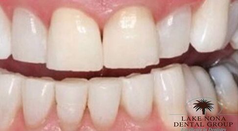 bright white smile after dental treatment