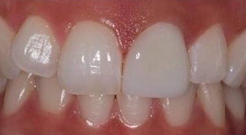 Top front tooth after it's brightened