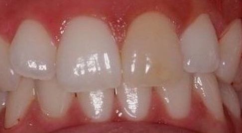 Discolored top front tooth