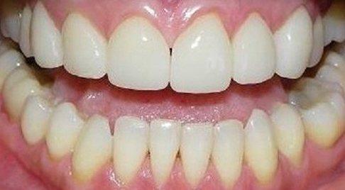 Smile after gap between teeth is closed