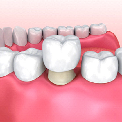 an illustration of the dental crown process in Lake Nona, FL