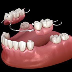 illustration for partial dentures 