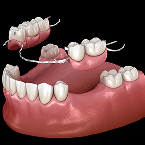 illustration for partial dentures