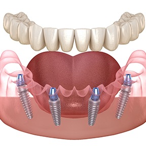 illustration for implant dentures
