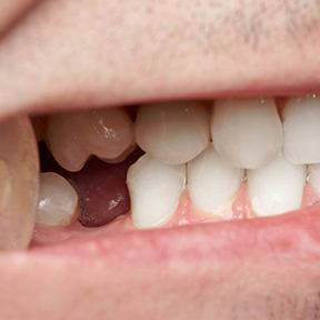 a closeup of a smile with a missing tooth