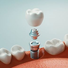 a 3D illustration of a dental implant and dental crown