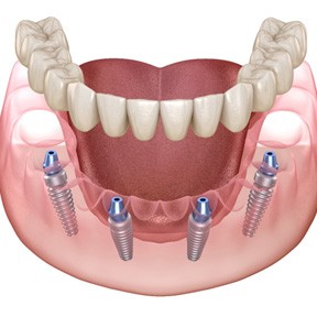 Illustration of dentures and dental implants in Lake Nona Region