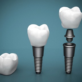 Diagram showing components of dental implants in Lake Nona
