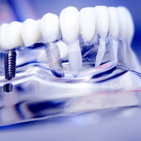 Dental implants in Lake Nona attached to model