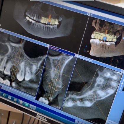 X-rays and surgical guides for dental implant tooth replacement
