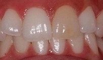 Closeup of patient's smile before dental care