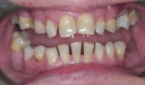 Closeup of patient's smile before dental implant tooth replacement