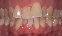 Closeup of patient's smile before Invisalign treatment