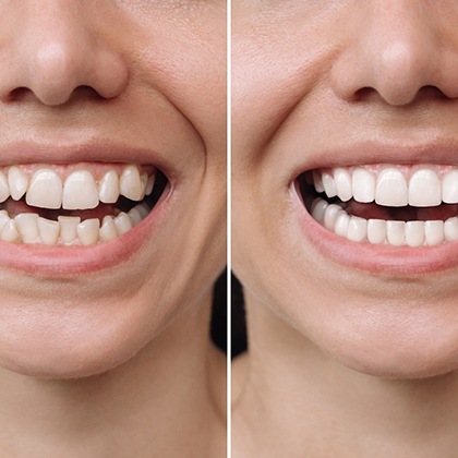 Before and after a patient receives veneers