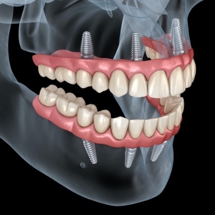 Animated smile with dental implant supported dentures