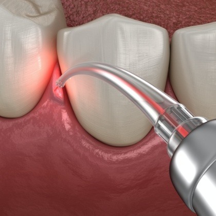 Patient receiving laser periodontal therapy