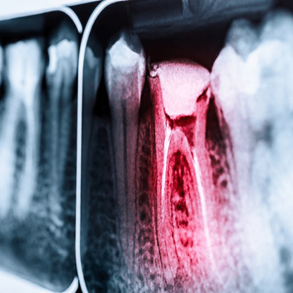 an X-ray displaying a patient’s root canal 