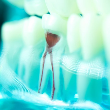 a model example of a root canal 