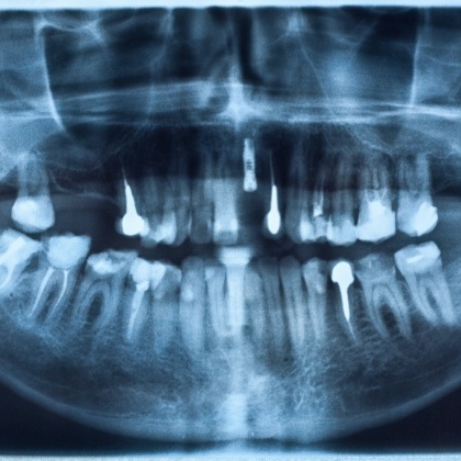 Digital dental x-rays