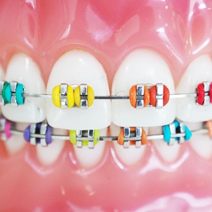 a closeup of traditional braces in Lake Nona