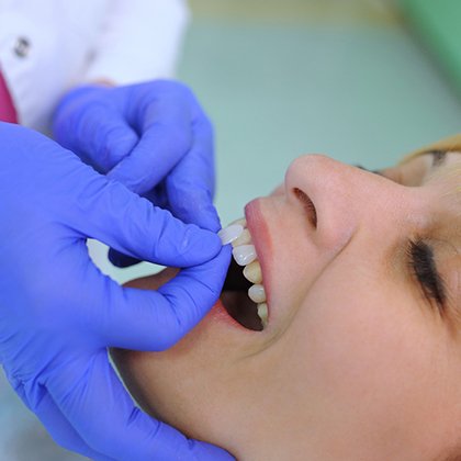 woman getting veneers in Lake Nona 